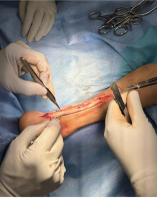 Achilles Tendon Repair Case 4 – Image 1