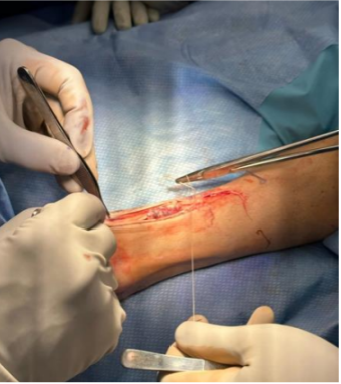 Achilles Tendon Repair Case 4 – Image 2