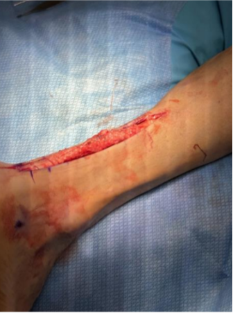 Achilles Tendon Repair Case 4 – Image 3