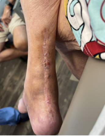 Achilles Tendon Repair Case 4 – Image 4