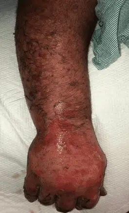Deep partial-thickness thermal burn - Case 3 - Image 1