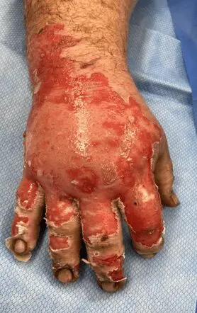 Deep partial-thickness thermal burn - Case 3 - Image 2