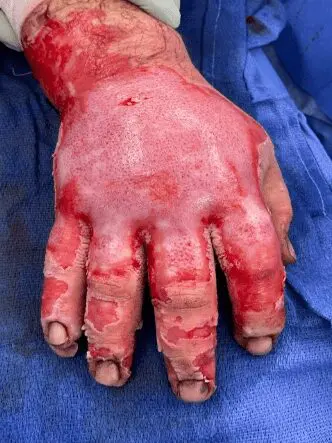 Deep partial-thickness thermal burn - Case 3 - Image 3
