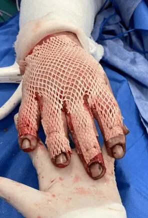 Deep partial-thickness thermal burn - Case 3 - Image 4