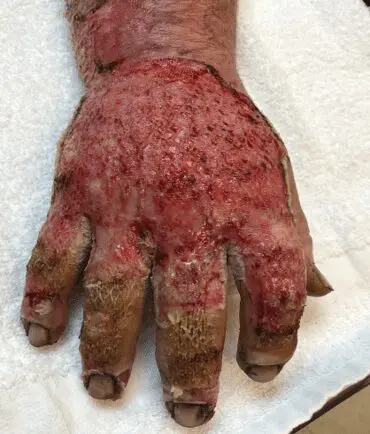 Deep partial-thickness thermal burn - Case 3 - Image 5