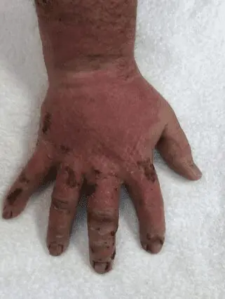 Deep partial-thickness thermal burn - Case 3 - Image 6