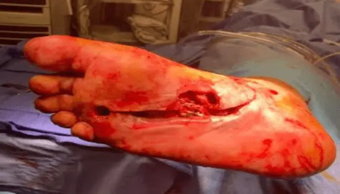Diabetic foot wound -case 2 - image 1