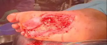 Diabetic foot wound -case 2 - image 2
