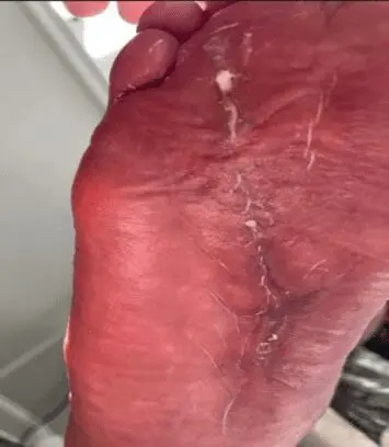 Diabetic foot wound -case 2 - image 4