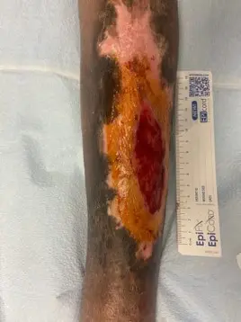 venous-leg-ulcers-1
