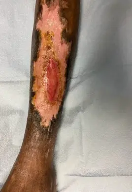 venous-leg-ulcers