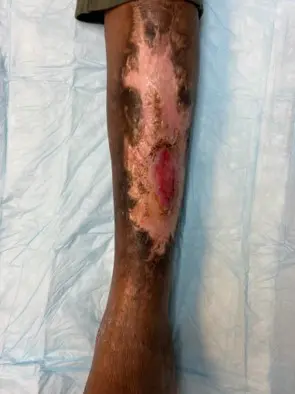 venous-leg-ulcers