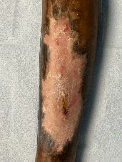 venous-leg-ulcers