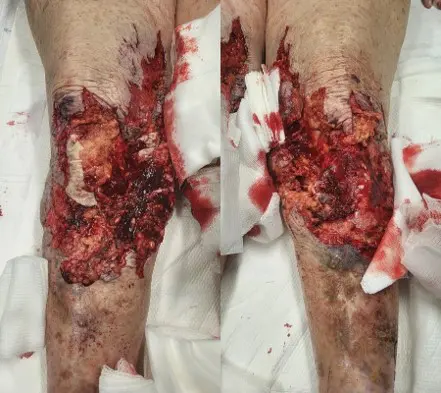 Bridging to Skin Graft