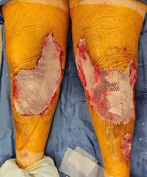 Bridging to Skin Graft
