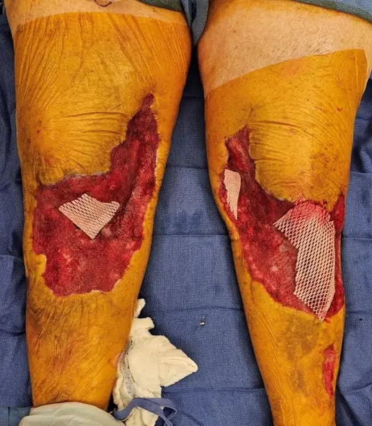 Bridging to Skin Graft