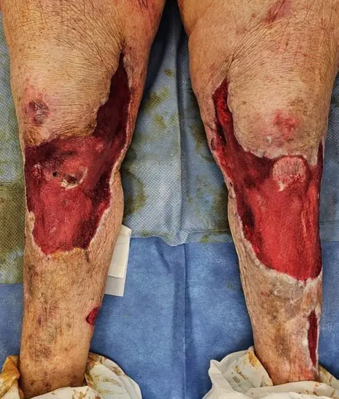 Bridging to Skin Graft