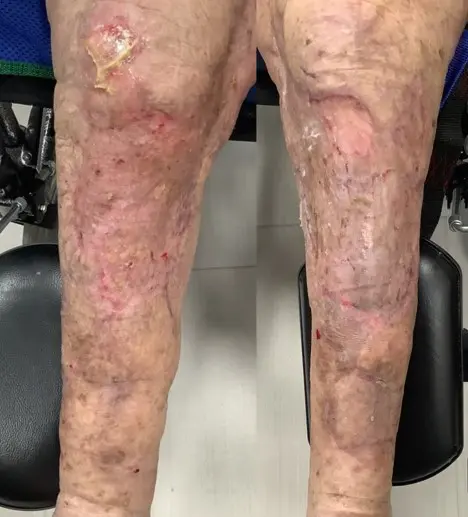 Bridging to Skin Graft