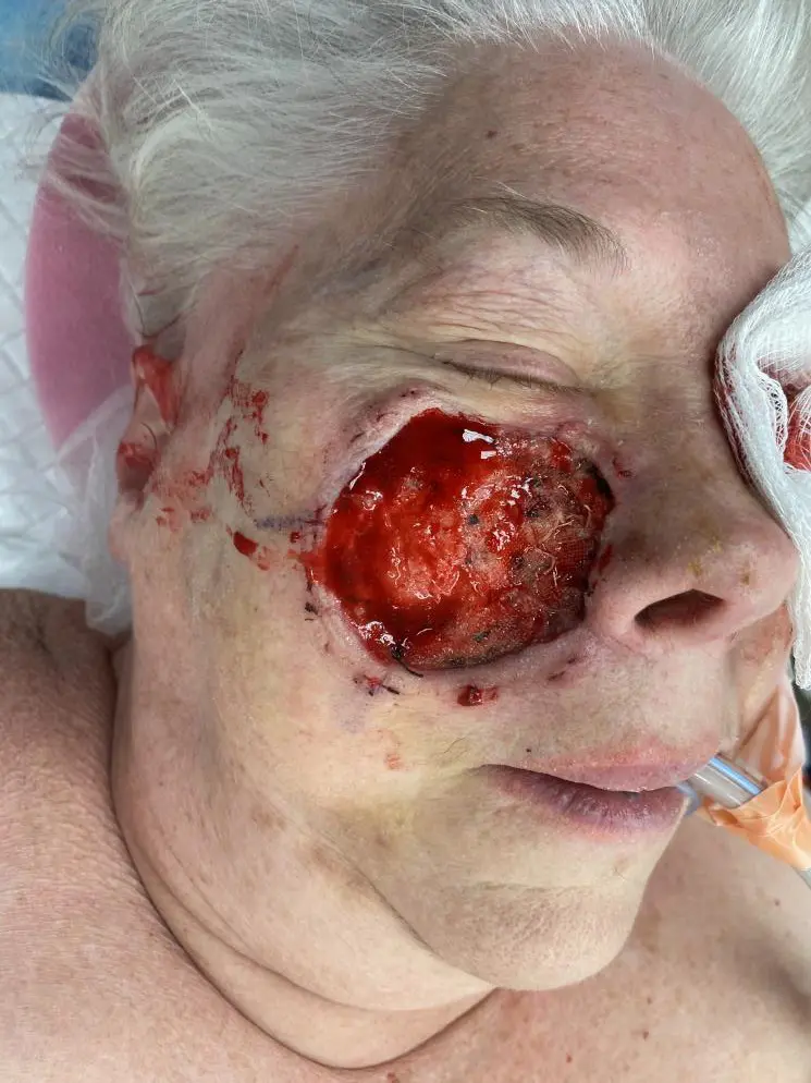 Melanoma in situ (right cheek) – staged excision and reconstruction