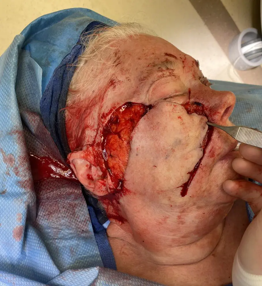 Melanoma in situ (right cheek) – staged excision and reconstruction