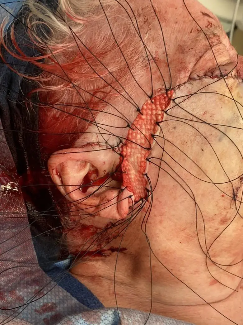 Melanoma in situ (right cheek) – staged excision and reconstruction