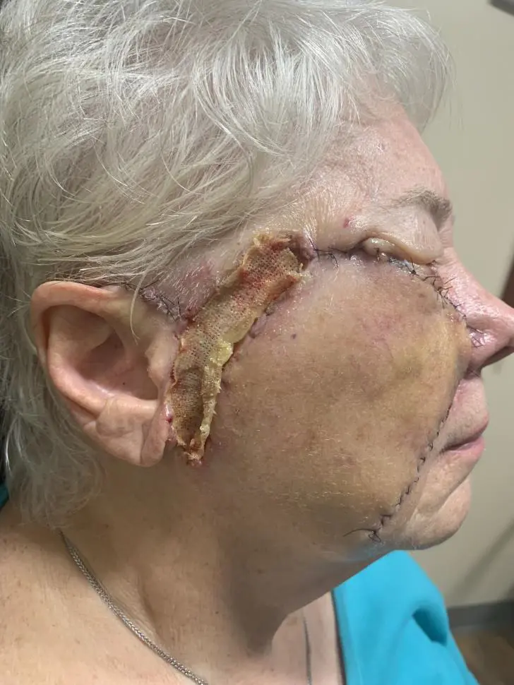 Melanoma in situ (right cheek) – staged excision and reconstruction