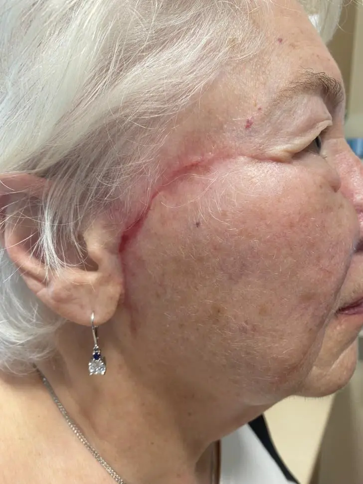 Melanoma in situ (right cheek) – staged excision and reconstruction