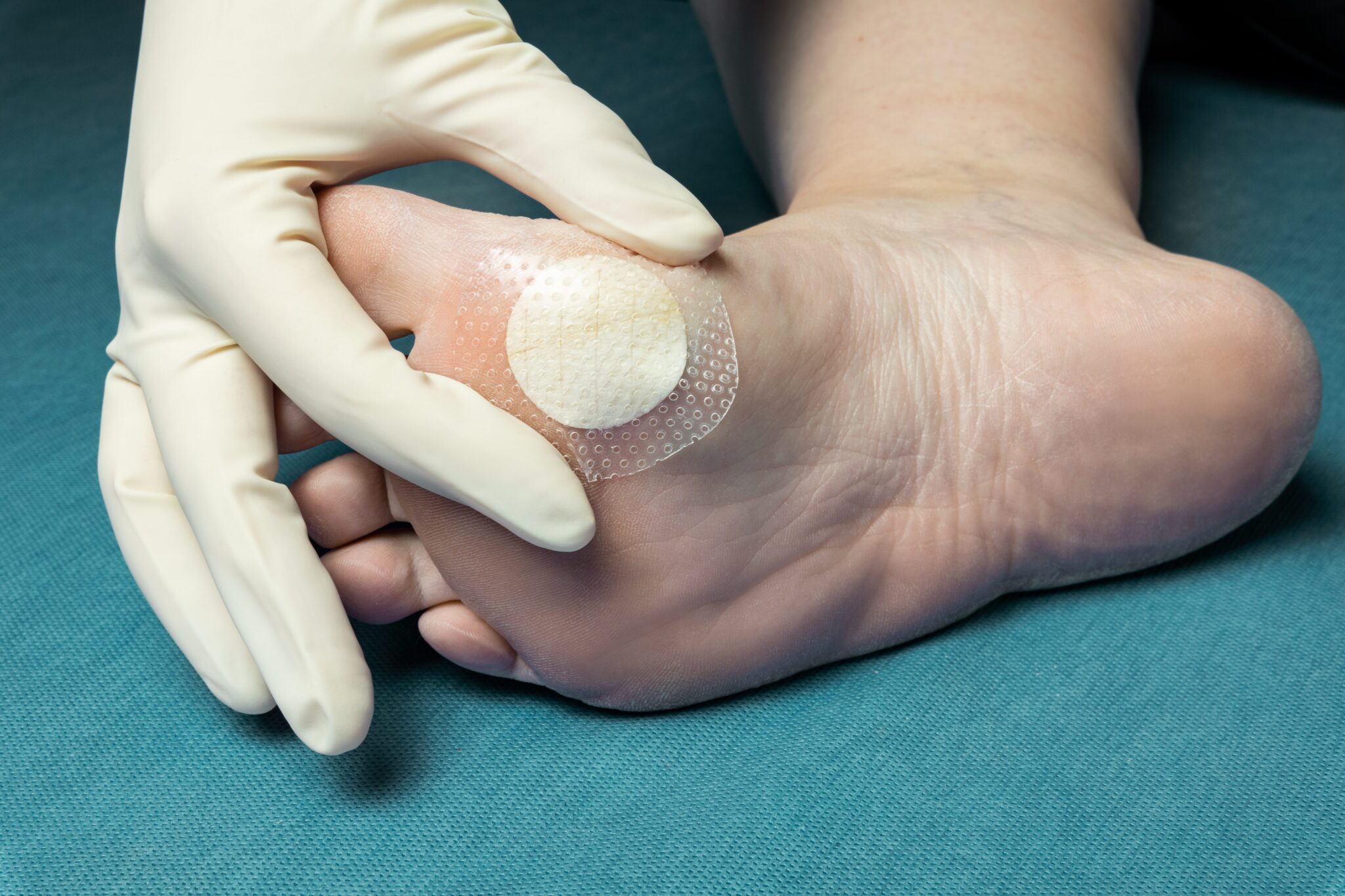 Shield Adhesive Kerecis