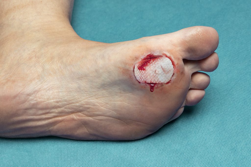 Foot ulcer with Kerecis fish skin