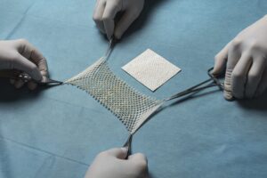 CMS Delays Skin Substitute Policy, Intact Fish-Skin Grafts Remain Covered on Existing LCDs
