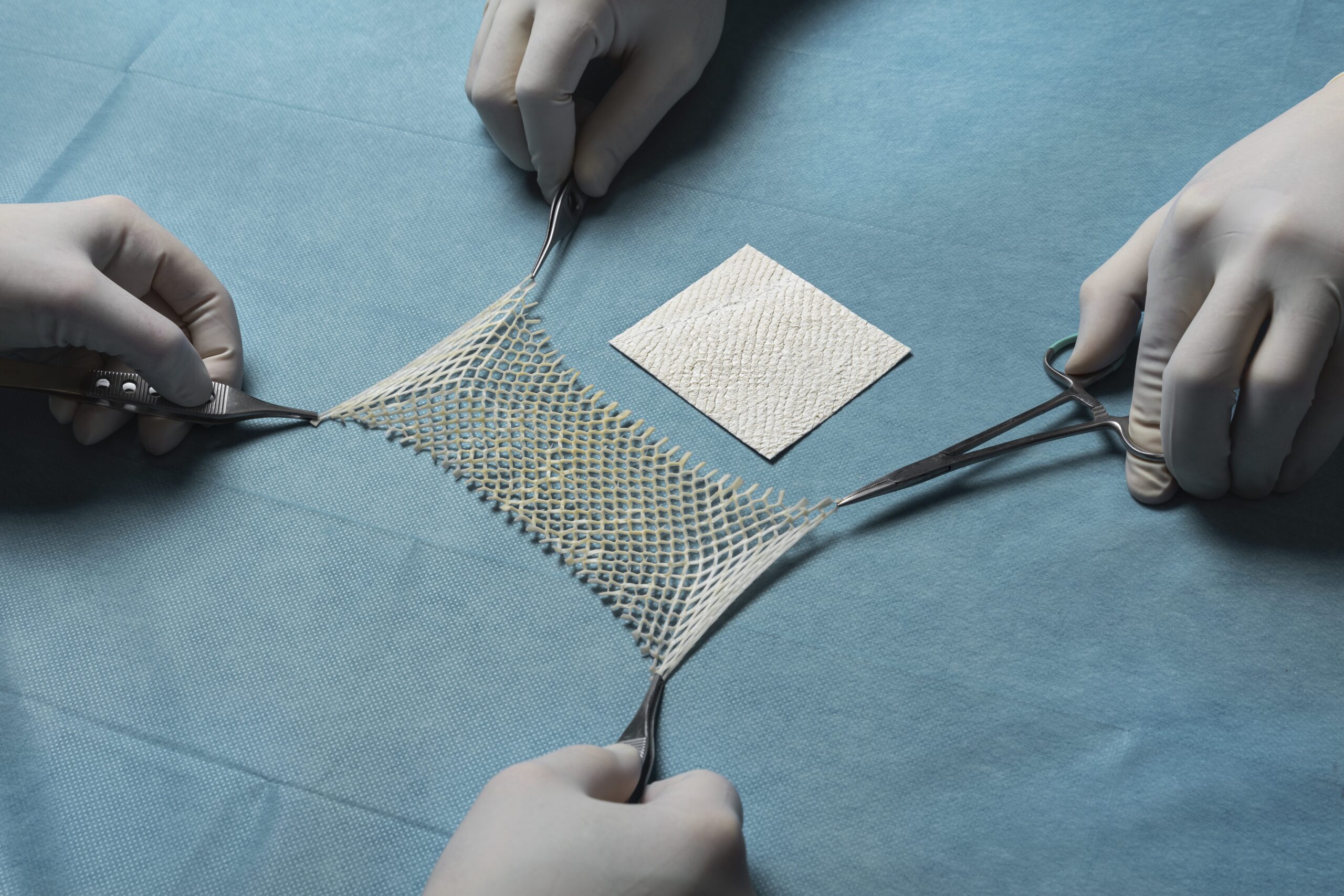 CMS Delays Skin Substitute Policy, Intact Fish-Skin Grafts Remain Covered on Existing LCDs